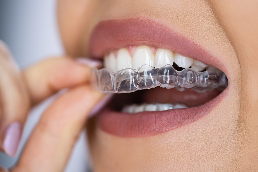 Invisalign Clear Aligners, Wagner Dental