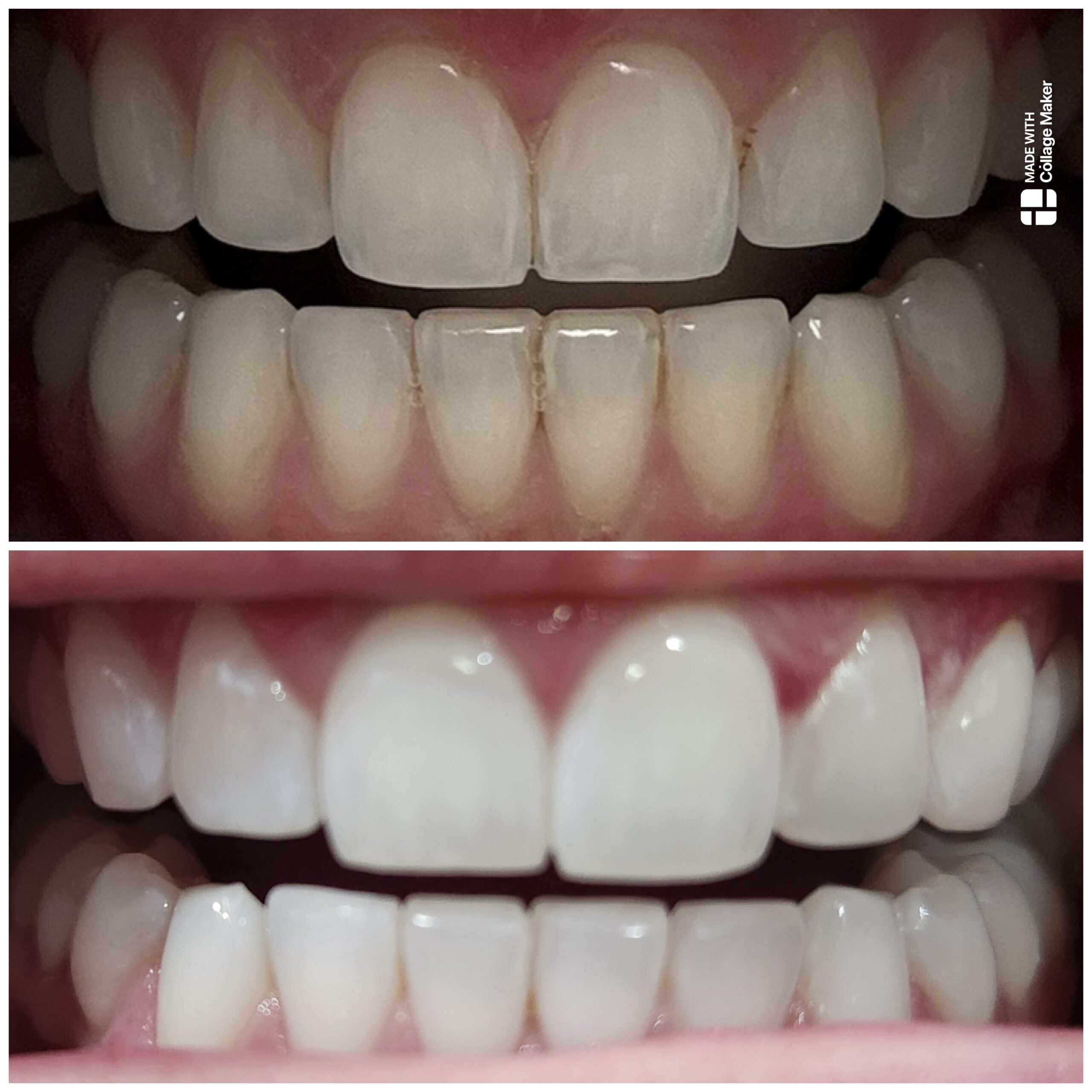Before & After - Whitening