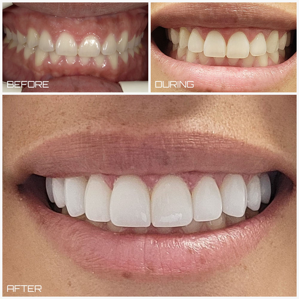 Veneers Case 1