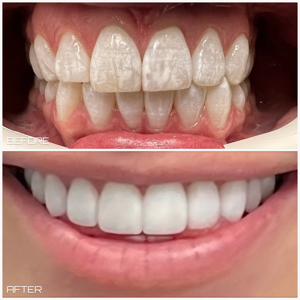 Veneers Case 2