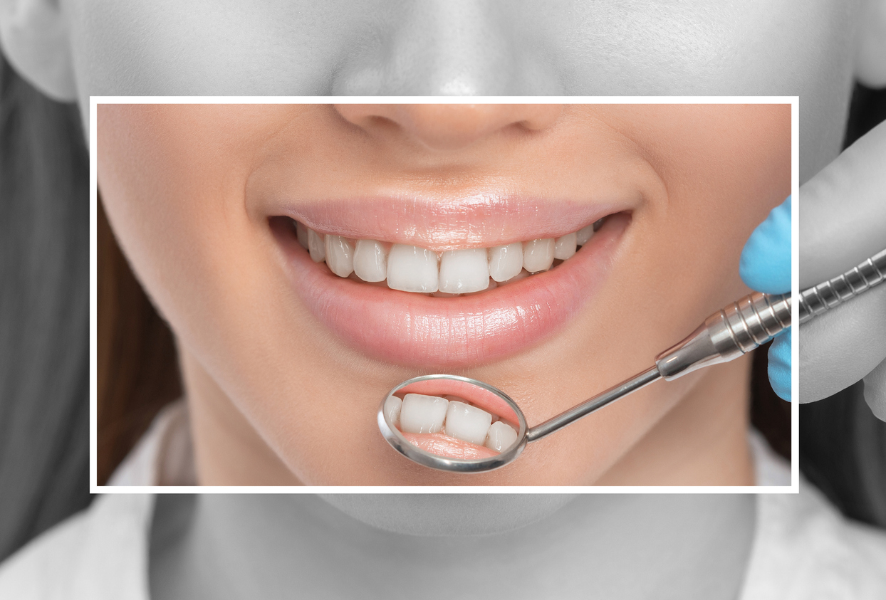Teeth Whitening Smile