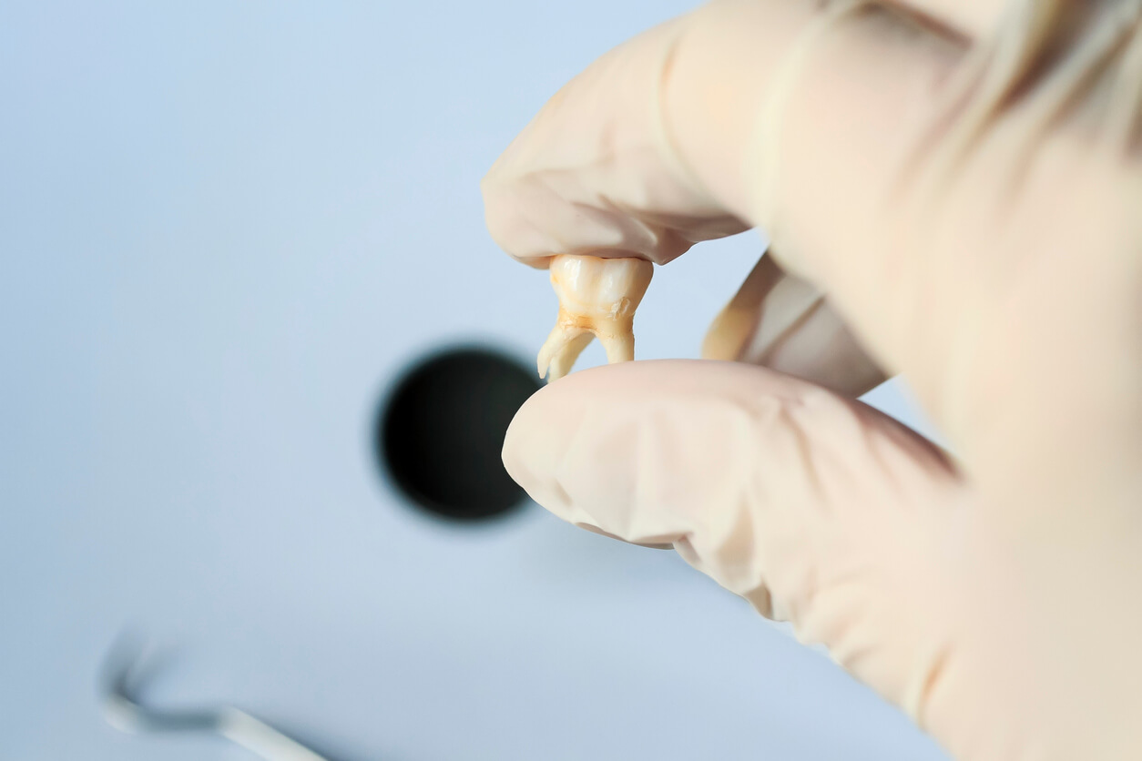 Wisdom Teeth Recovery After Removal Wisdom Teeth Recovery