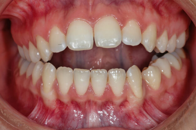 open bite symptoms what is an open bite in teeth