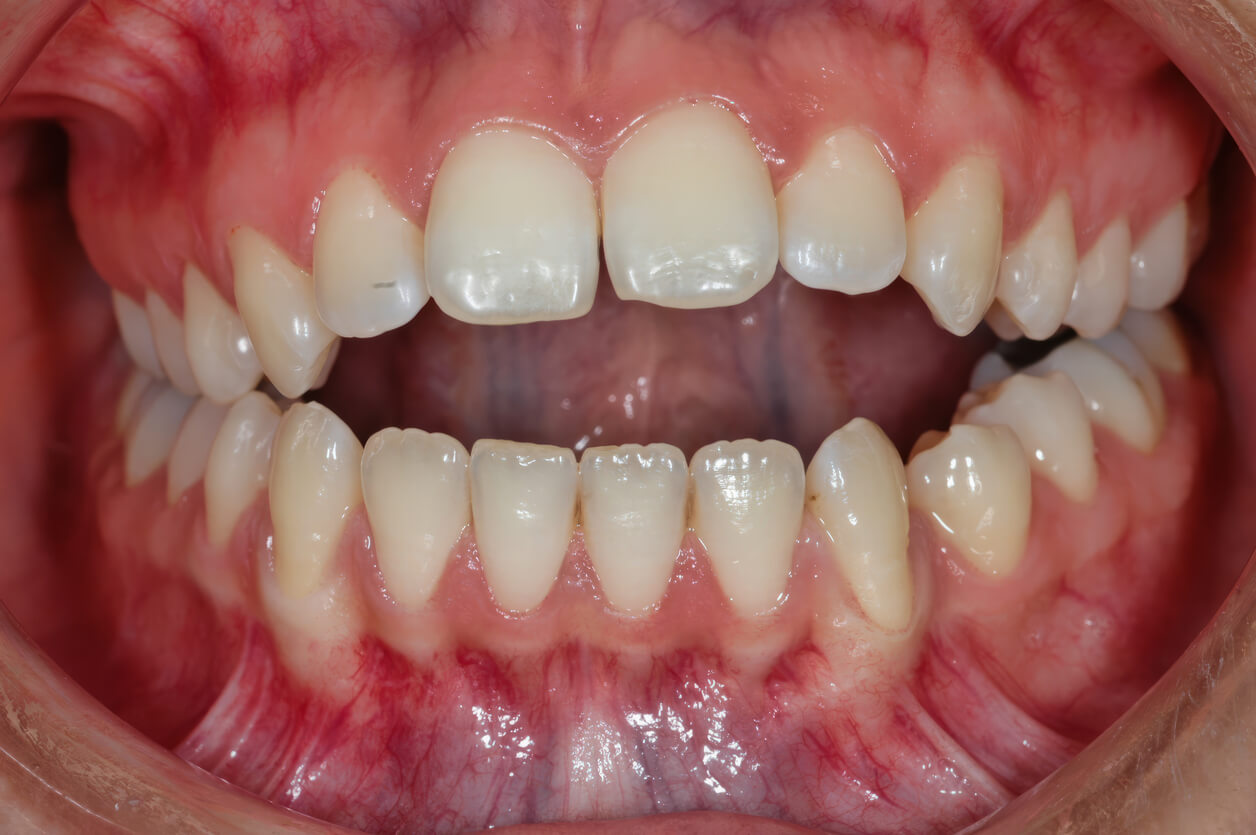 what is an open bite in teeth