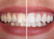 Teeth Bleaching vs Whitening