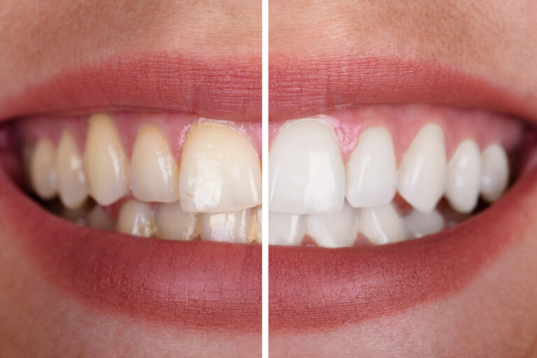 Teeth Bleaching vs Whitening