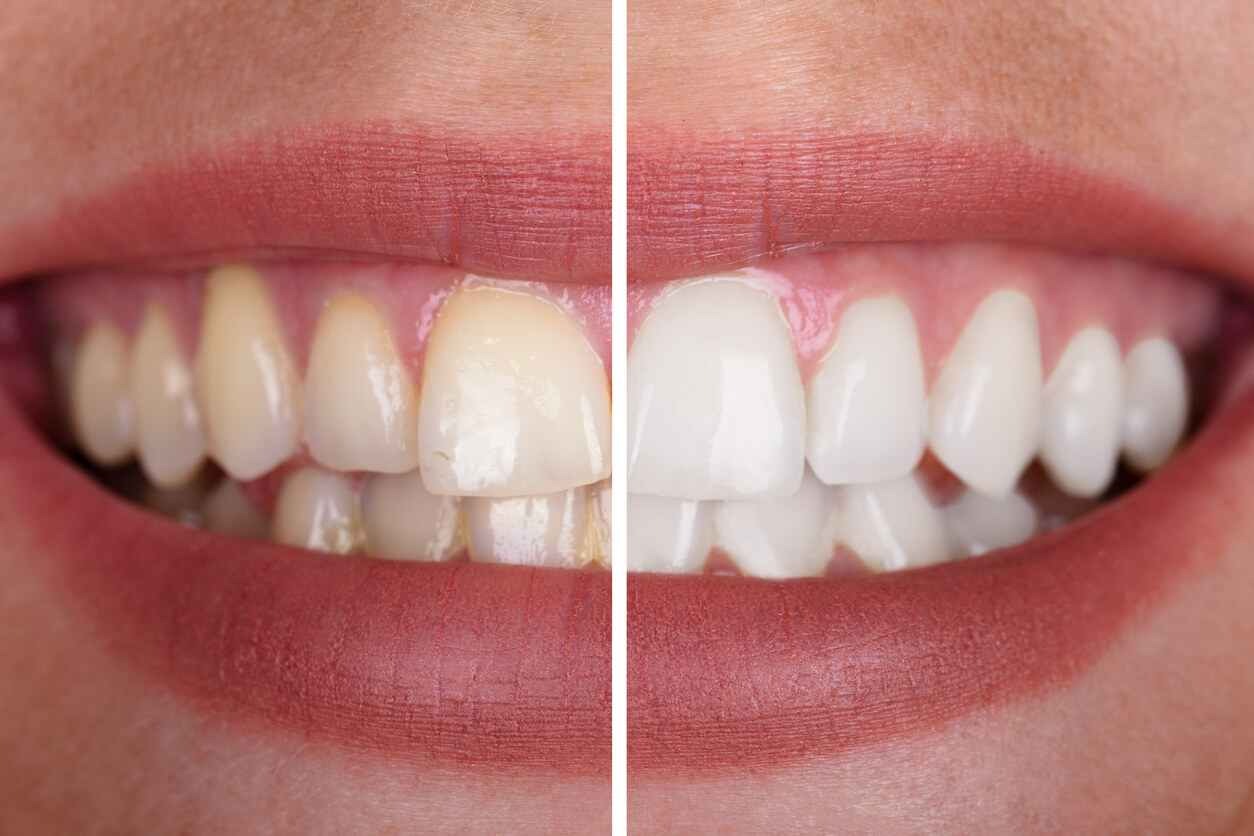 Teeth Bleaching vs Whitening