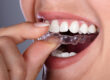 Do Clear Aligners Hurt