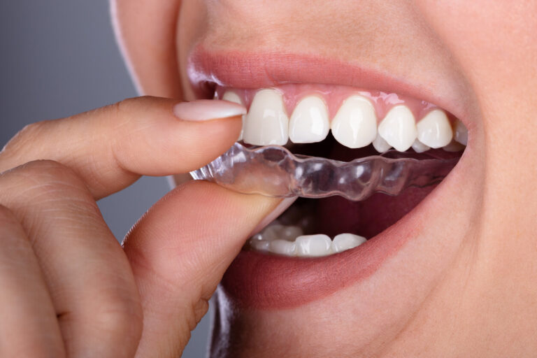 Do Clear Aligners Hurt